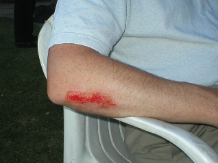 Rob Harvey's arm.